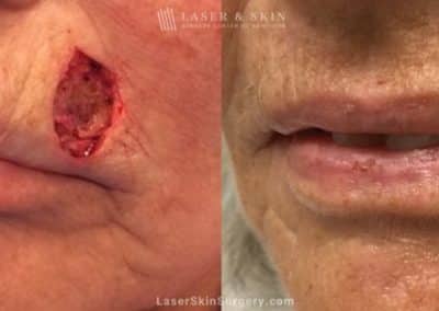 Mohs Micrographic Surgery for the Removal of Skin Cancer