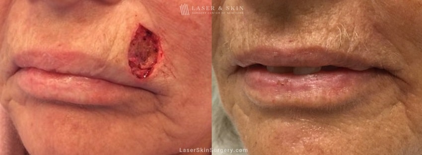 before and after image of mohs surgery for the removal of skin cancer just above a woman's lip