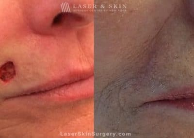 Mohs Micrographic Surgery for the Removal of Skin Cancer