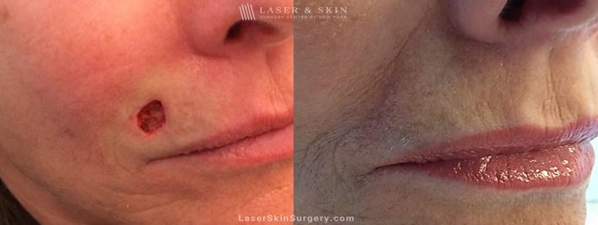 before and after image of mohs surgery for the removal of skin cancer just above the side of a woman's lip