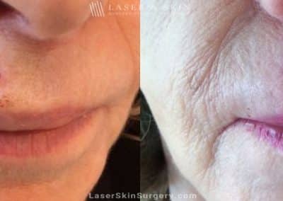 Mohs Micrographic Surgery for the Removal of Skin Cancer Above the Lip