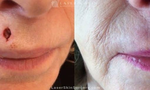 Mohs Micrographic Surgery for the Removal of Skin Cancer Above the Lip