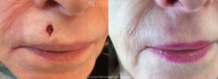 before and after image of mohs surgery for the removal of skin cancer under a woman's nose