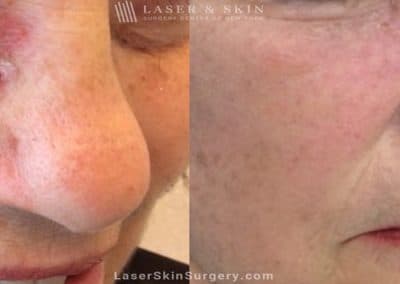 Mohs Micrographic Surgery for the Removal of Skin Cancer Under the Eye