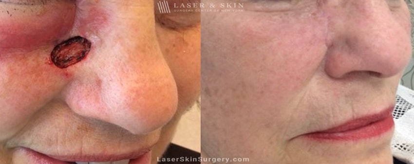 before and after image of mohs surgery for the removal of skin cancer under a woman's eye