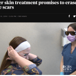 Dr. Jeremy A. Brauer featured on CBS News: Picosure and Acne Scarring