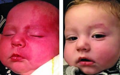 Roy G. Geronemus, M.D, and Colleagues featured in Dermatology Times: Study examines port-wine stain treatment in infants