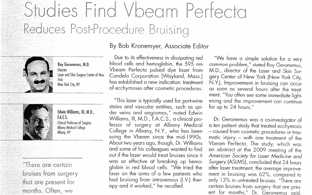 vbeam perfecta bruising treatment article new york