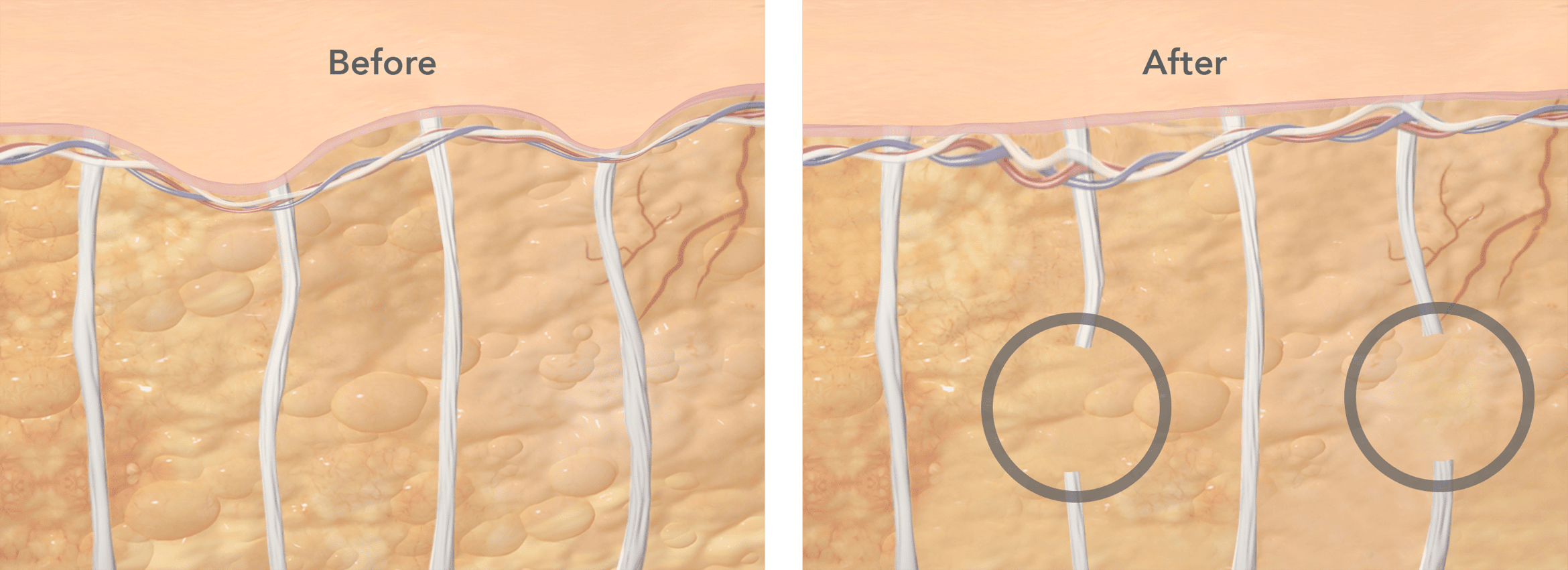 cellulite laser treatment before and after diagram cellulite laser treatment before and after diagram