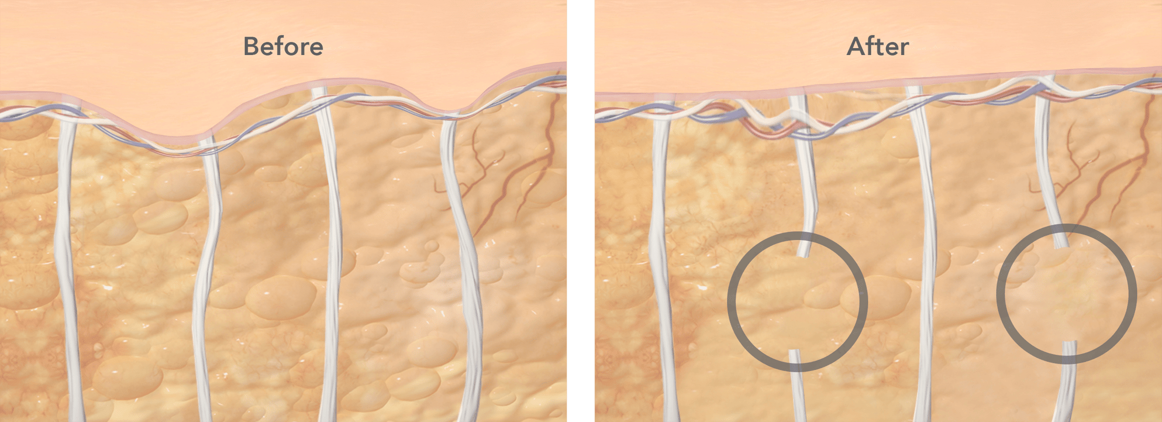 cellulite laser treatment before and after diagram