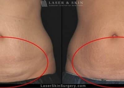 Coolsculpting for Unwanted Belly Fat