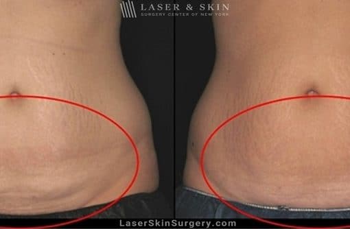 Coolsculpting for Unwanted Belly Fat