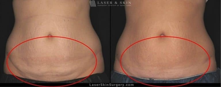 Coolsculpting for Unwanted Belly Fat