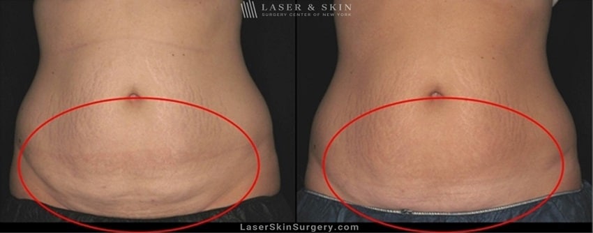 before and after image of a coolsculpting treatment for unwanted belly fat on a woman