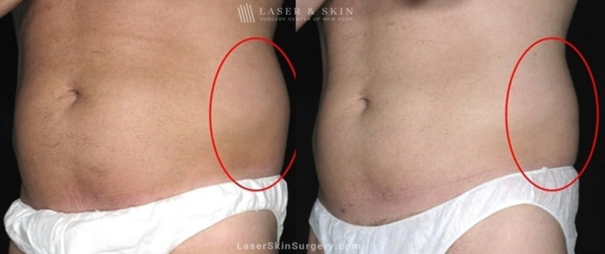 before and after image of a coolsculpting treatment for unwanted belly fat on a man's midsection