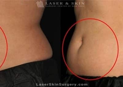 Coolsculpting for Unwanted Belly Fat