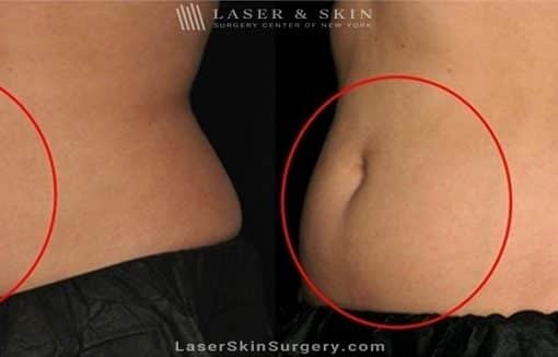 Coolsculpting for Unwanted Belly Fat