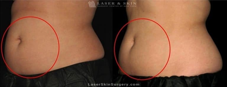 Coolsculpting for Unwanted Belly Fat