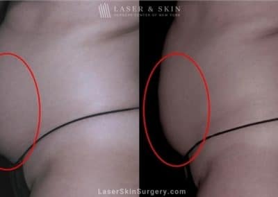 Coolsculpting for Unwanted Belly Fat