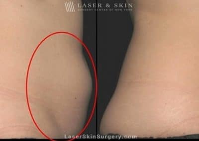 Coolsculpting for Unwanted Belly Fat