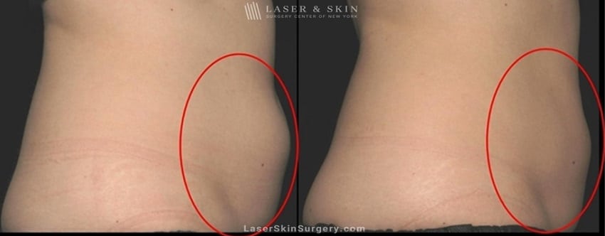 before and after image of a coolsculpting treatment for unwanted belly fat on a woman