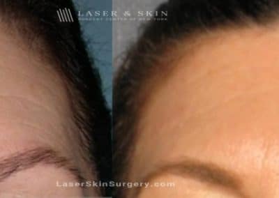 Dysport Injections to Reduce the Appearance of Wrinkles in the Forehead