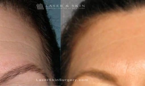 Dysport Injections to Reduce the Appearance of Wrinkles in the Forehead