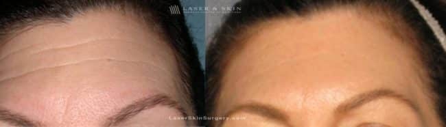 before and after image of dysport injections to reduce the appearance of wrinkles in a woman's forehead