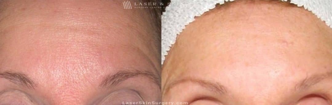 before and after image of dysport injections to reduce the appearance of wrinkles in a woman's forehead