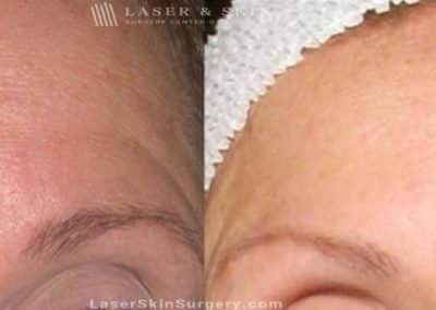 Dysport Injections to Reduce the Appearance of Wrinkles in the Forehead