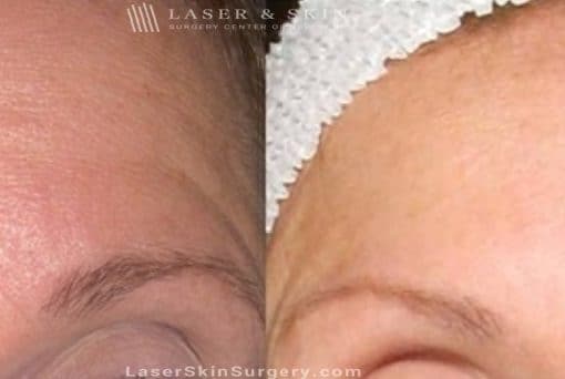 Dysport Injections to Reduce the Appearance of Wrinkles in the Forehead