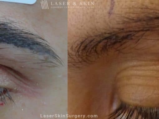 Laser Treatment for Permanent Makeup Removal on an Eyebrow