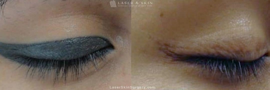 before and after image of a laser treatment to remove permanent makeup on a woman's eyelid