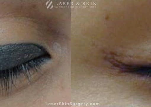 Laser Treatment for Permanent Makeup Removal on an Eyelid