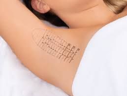 miradry laser treatment in nyc