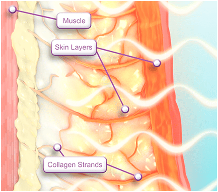 how does thermage work