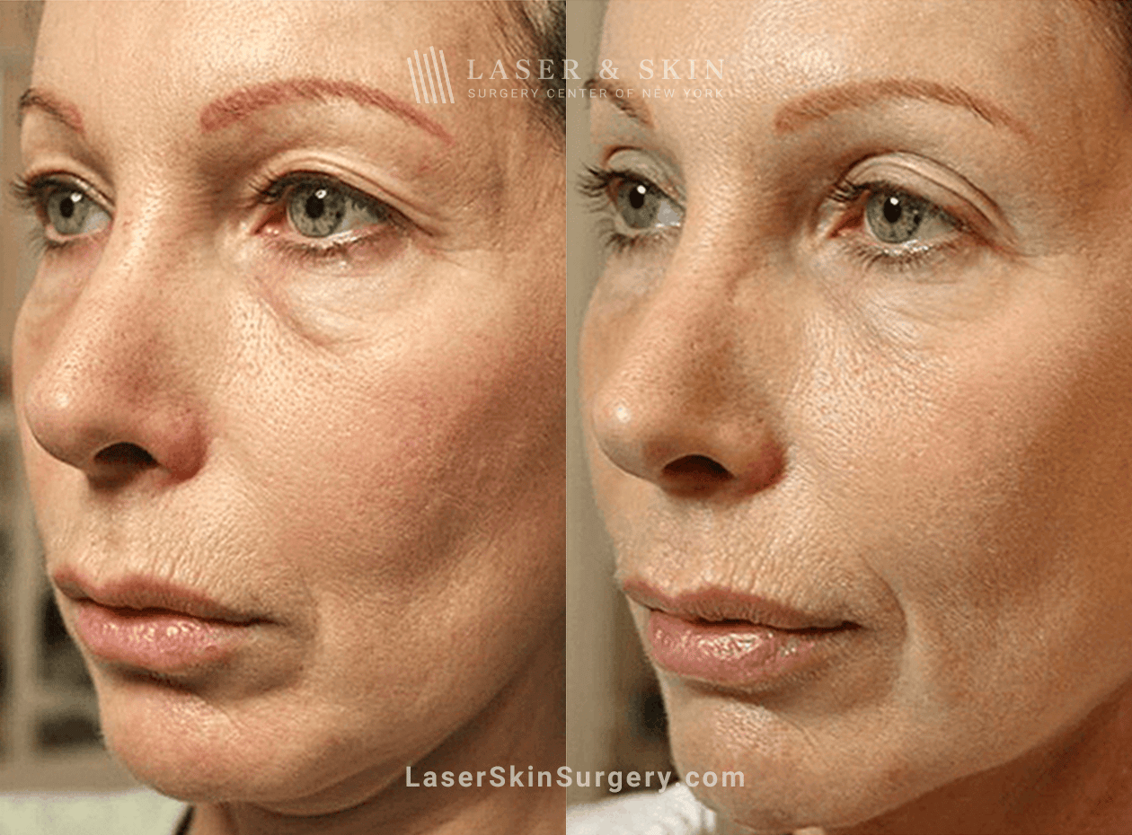 thermage for wrinkles before and after