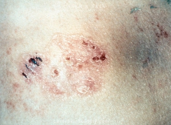 lsscny example of basal cell carcinoma on skin new york, ny