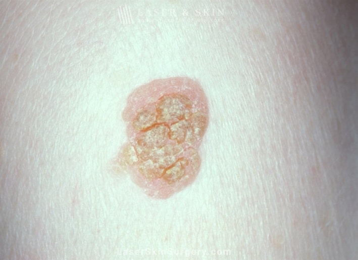 benign-look-alikes-new-york-new-york-city-1145 types of moles that should be removed