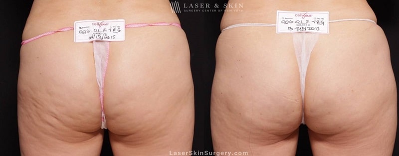 before and after image of a cellfina treatment to improve the appearance of cellulite on the buttocks