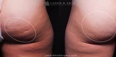 Cellfina to Improve the Appearance of Cellulite