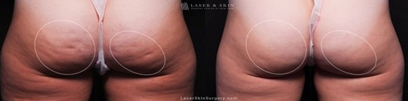 before and after image of a cellfina treatment to improve the appearance of cellulite on the buttocks