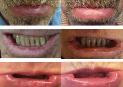Fraxel Laser Treatment for Actinic Cheilitis