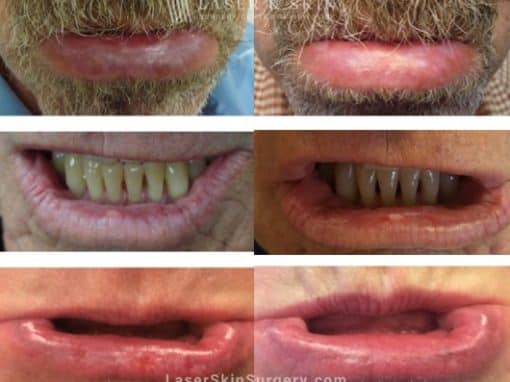 Fraxel Laser Treatment for Actinic Cheilitis