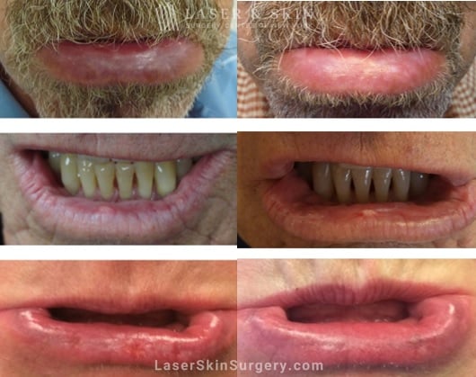 before and image of a fraxel laser treatment for actinic cheilitis