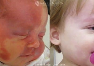Laser Treatment for Port Wine Birthmark Removal on a Baby’s Face