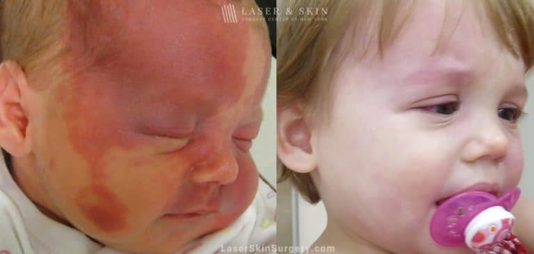 Laser Treatment for Port Wine Stain Removal on a Baby’s Face