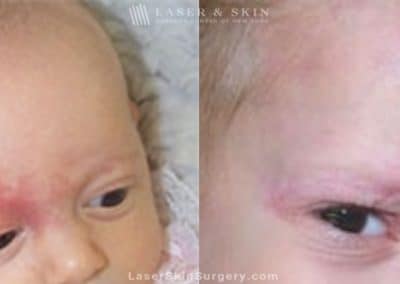 Laser Treatment for the Removal of a Birthmark on a Baby’s Face
