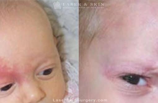 Laser Treatment for the Removal of a Birthmark on a Baby’s Face