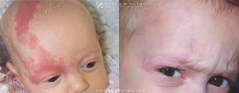 Laser Treatment for the Removal of a Birthmark on a Baby’s Face